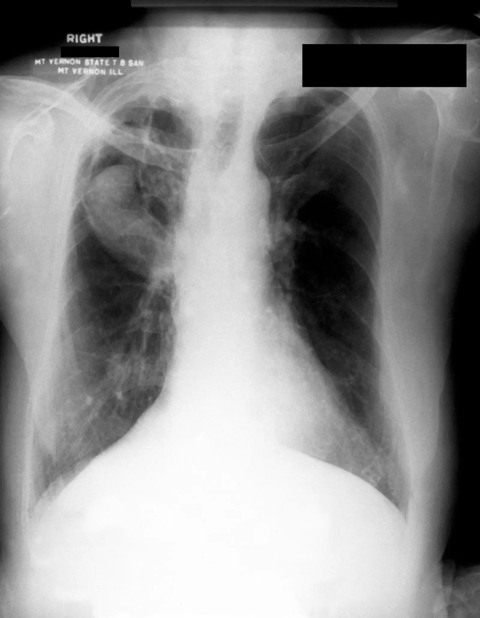a chest radiograph showing lungs