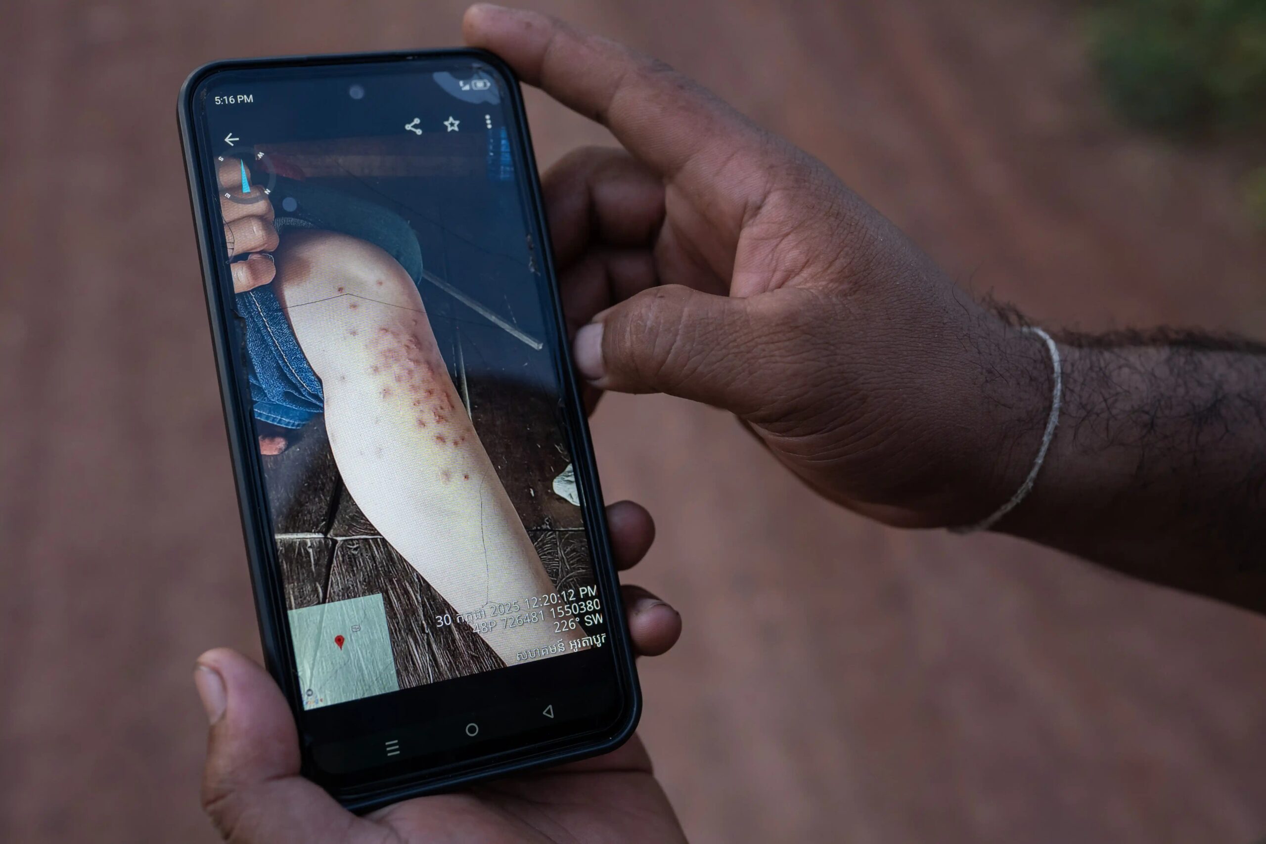 A resident shows reporters a photo taken on July 30, 2025, of his sister’s leg after she entered the O’Ta Bouk river to bathe. They told reporters that the red welts developed around three days after her skin made contact with the water. Photo by Andy Ball/Mongabay.