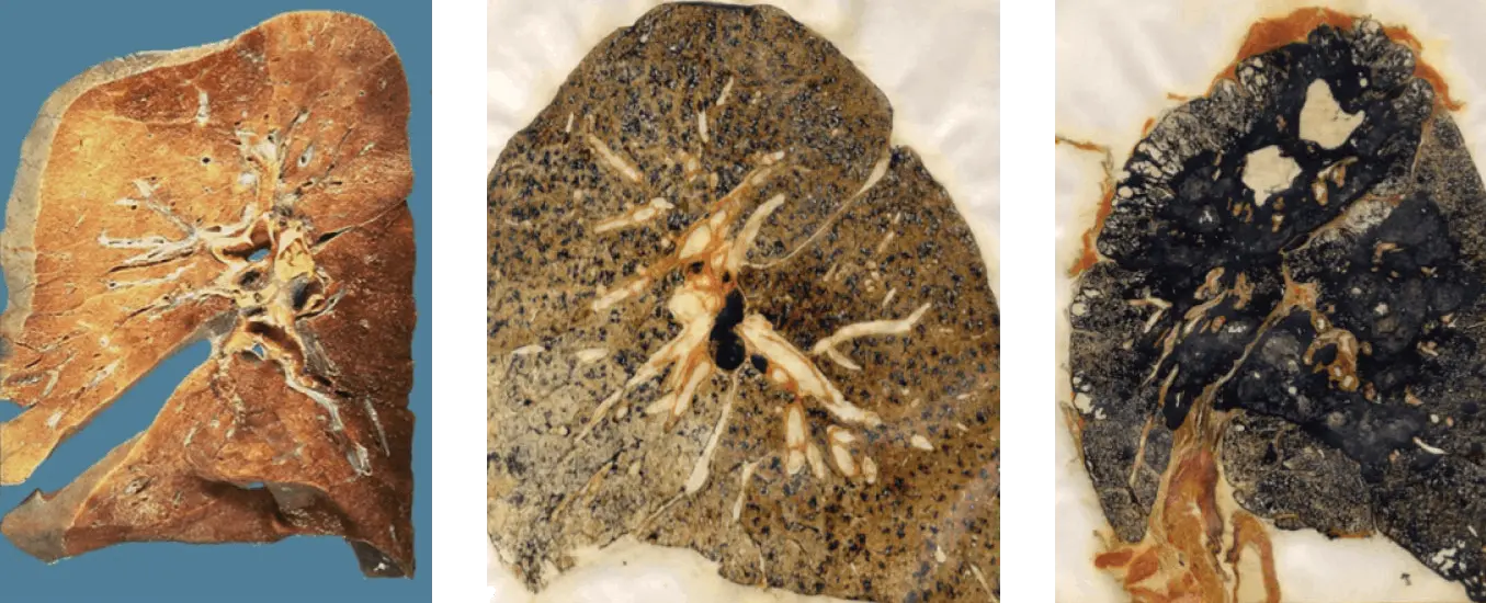 Three upsetting images of lungs damaged by black lung disease
